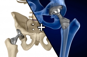 New strategies for orthopedic CoCrMo parts machining