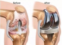 Efficient milling of cobalt, chromium, molybdenum(CoCrMo) and titanium alloy hip joints for medical prosthetic implant parts